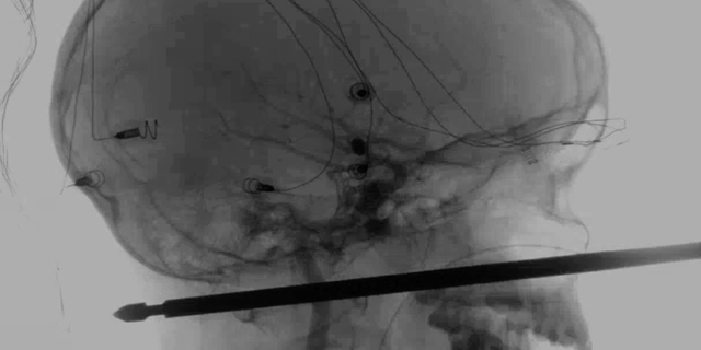 This X-ray provided by the Medical News Network shows a meat skewer impaled in the skull of Xavier Cunningham after an accident at his home Saturday, Sept. 8, 2018, in Harrisonville, Mo. Cunningham's experience began when yellow jackets attacked him in a tree house and he tumbled from the tree, landing on the skewer. The skewer had completely missed the boy's eye, brain, spinal cord and major blood vessels and doctors think he could recover completely. (Medical News Network via AP)