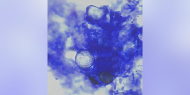 Oocysts of Cyclospora cayetanensis stained with modified acid-fast stain.