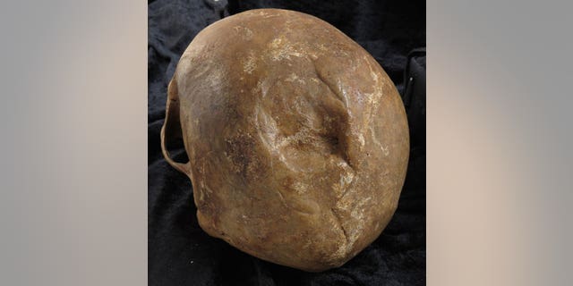 The smooth edges of this skull fracture suggest that the injury healed after the skull's owner, a man buried in Odense, Denmark, was hurt.