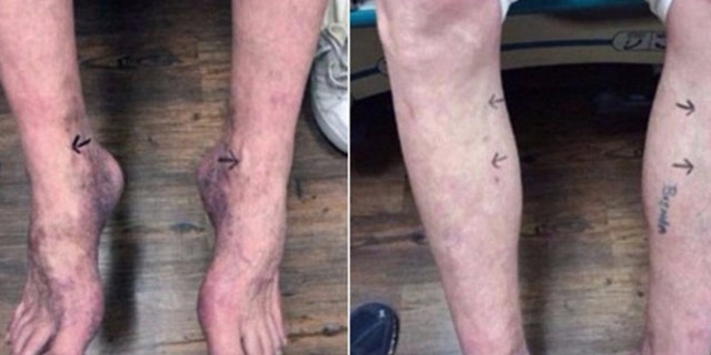 Photos entered in court records show Doyle Lee Hamm's veins, and contend the veins in his lower extremities are more accessible.
