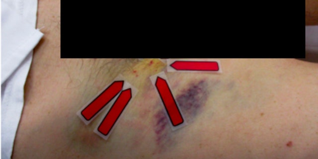 Injuries to Doyle Lee Hamm's groin area after his "botched" execution last month.