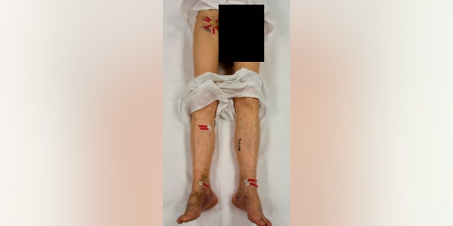 Injuries to Doyle Lee Hamm after his "botched" execution last month.
