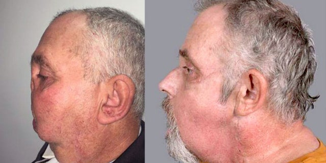 Prior to the surgery, he had trouble breathing, eating, sleeping and speaking.