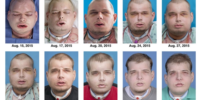 This combination of Aug. 15, 2015 to Nov. 11, 2015 photos provided by the New York University Langone Medical Center shows the recuperation of Patrick Hardison after his facial transplant surgery in New York.