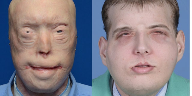 This combination of photos provided by the New York University Langone Medical Center shows Patrick Hardison before and after his facial transplant surgery in New York.
