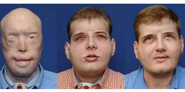 Patrick Hardison is "thriving" one year after the most extensive face transplant ever performed. From left to right, Hardison before surgery, five months after surgery, and one year after surgery.