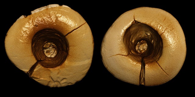 Archaeologists discovered a 13,000-year-old skeleton with two front teeth that have big holes in the surface that reach down to the tooth's pulp chamber.