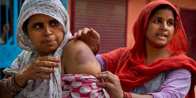 Nov. 7, 2014: Bhuri Begum, right, pulls down the sleeve of Farhad's shirt to display bruises caused allegedly by police beating after security was enhanced in the area following rioting between Hindus and Muslims in New Delhi