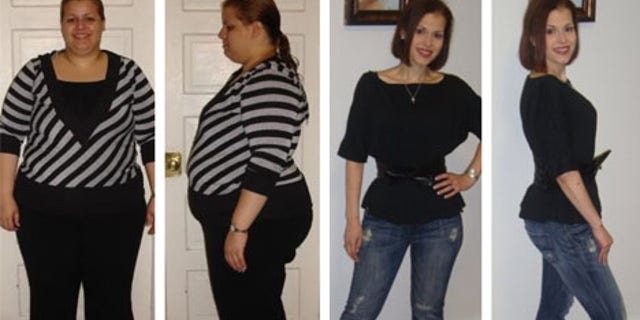 Jassira before and after her duodenal switch.