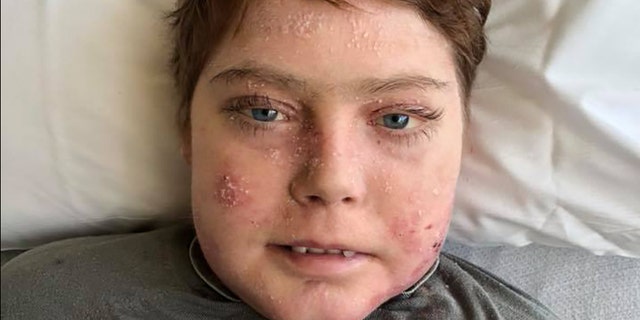 Jonathan Pitre died after suffering from a rare skin disease that gave him the nickname "butterfly boy."