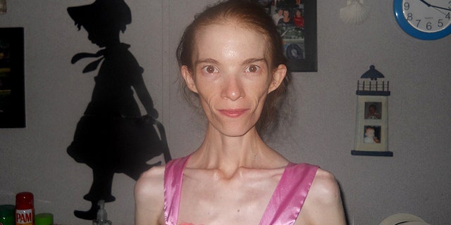 Katrina Howard, 25, who weighed 58 pounds, was told that she would have to travel out of Georgia if she wanted to receive treatment for her anorexia.