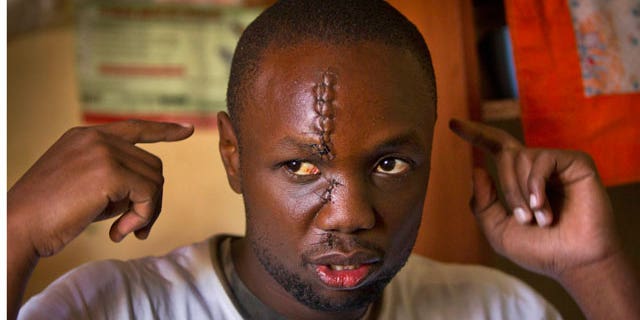 Jan. 31, 2012: Kenyan Anthony Omari, 24, describes the attack during which he suffered a machete slash to the face while defending one of Kenya's under-resourced orphanages from a half dozen machete-wielding thugs.