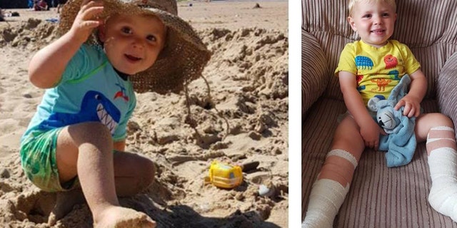 Laura Ashford said her two-year-old son, Harri, suffered severe burns after he touched the remnants of a beachfire that was buried underneath sand at a Welsh beach.