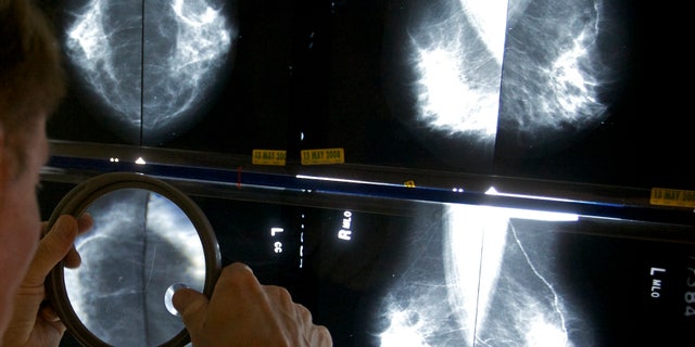 FILE - In this Thursday, May 6, 2010 file photo, a radiologist uses a magnifying glass to check mammograms for breast cancer in Los Angeles. A Canadian study published Wednesday, Feb. 12, 2014 in the British journal BMJ has revived a debate about the value of mammograms. The study suggests that screening X-rays do not lower the risk of dying of breast cancer while finding many tumors that do not need treatment. Critics say the researchers used outdated equipment and methods that made mammograms look unfairly ineffective. (AP Photo/Damian Dovarganes, File)