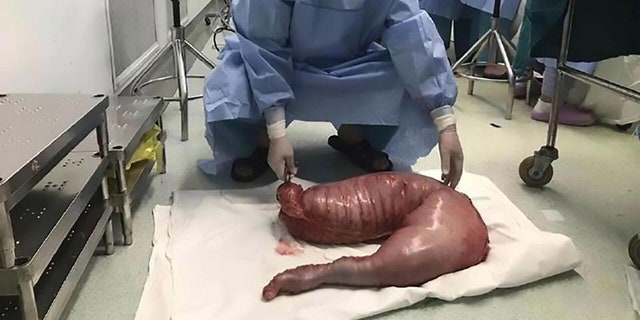 The section of colon that was removed was 30 inches long and weighed nearly 29 lbs.