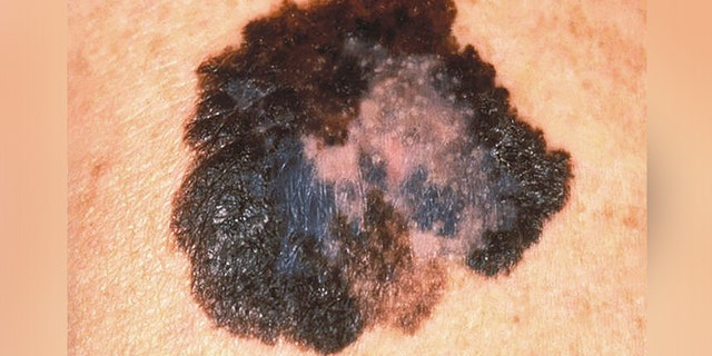 This image depicts the gross appearance of a cutaneous pigmented lesion, which had been diagnosed as superficial spreading malignant melanoma (SSMM).