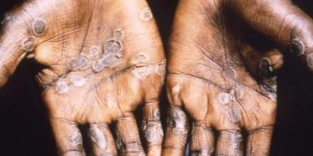 Monkeypox is considered mild and typically occurs in remote parts of central and west Africa.