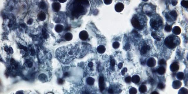 Naegleria fowleri in human brain tissue. (CDC.GOV)