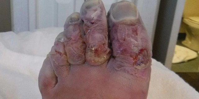 Three of Griffith's toes needed to be amputated following the Yukon Arctic Race in February.