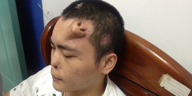 A new nose, grown by surgeons on Xiaolian's forehead, is pictured before being transplanted to replace the original nose, which is infected and deformed, at a hospital in Fuzhou, Fujian province.