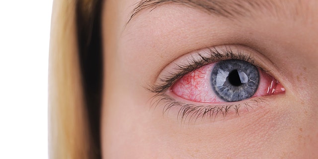 The infection can affect the thin, clear membrane that protects the eye, leading to a condition called conjunctivitis, commonly known as pink eye.