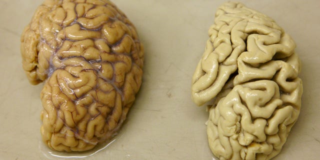 One hemisphere of a healthy brain (L) is pictured next to one hemisphere of a brain of a person suffering from Alzheimer disease, at the Belle Idee University Hospital near Geneva March 14, 2011. (REUTERS/Denis Balibouse)