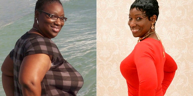 A 50-year old woman told SWNS that when lost 150 pounds, she was able to get rid of a chronic skin problem called Hidradenitis Suppurativa.