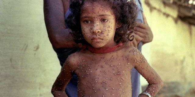 A child affected by the smallpox virus.