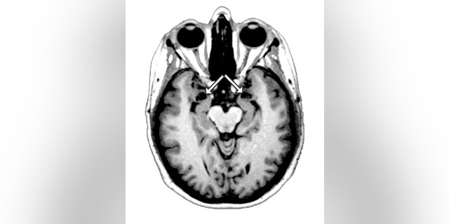An undated image of a brain scan provided by the University of Iowa Department of Neurology, shows an MRI scan of patient SM's brain. The arrows point to the amygdala, the region of the brain which SM is missing, as shown by the vacant black holes underneath the arrows. (AP Photo/University of Iowa Department of Neurology) NO SALES