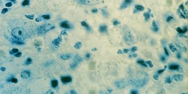 An unnamed female patient, who lives in Southport and is between the ages of 15 and 25, reportedly was diagnosed with donovanosis within the last 12 months.