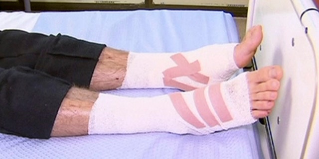 In this image made from video, legs of Sam Kanizay, 16, are seen on a bed of a hospital where he is treated, in Melbourne, Australia, Monday, Aug. 7, 2017. Kanizay walked out of the water with his feet and ankles covered in what looked like hundreds of little pin holes that were bleeding profusely. Kanizay's father, Jarrod, said hospital staff had no idea what kind of creature could have caused the injuries. (Australia Pool via AP)