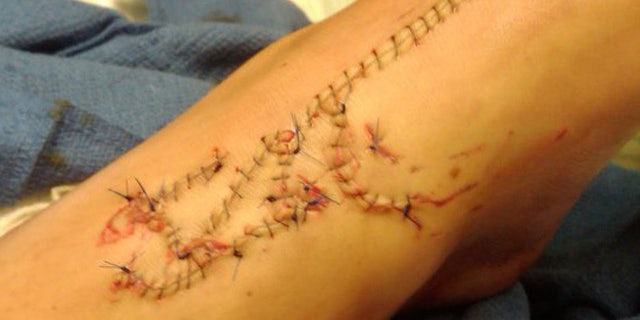 Carley Schlentz, 13, of Greensboro, was swimming with friends at Topsail Island on Friday when she bitten by a shark twice near the top of her left foot. (Fox8.com)