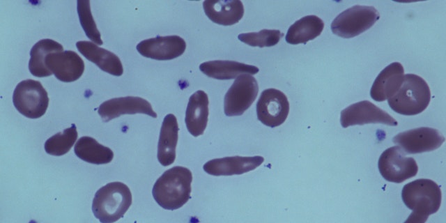This image provided by the National Institutes of Health shows red blood cells in a patient with sickle cell disease at the National Institutes of Health Clinical Center in Bethesda, Md.