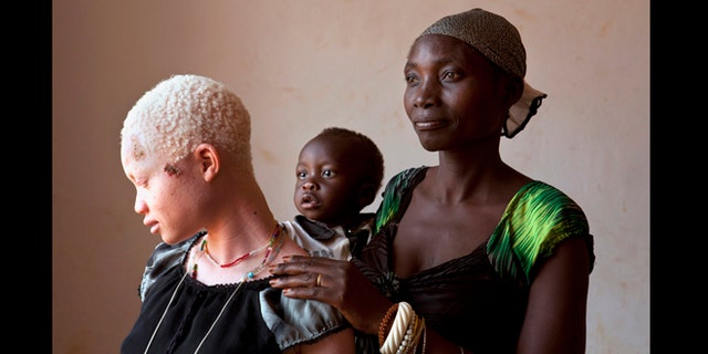 This photo taken Aug. 29, 2012 shows Angel Salvatory, 17, who has skin cancer, with her half-brother Ezekiel and mother Bestida, who she had not seen in the four years she has lived away from home, after her own father led a group of men to attack her, seen at Kabanga Protectorate Center, in Kabanga, Tanzania.