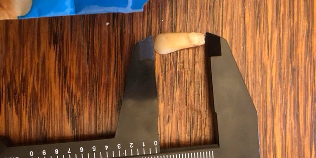 Botsford said once she discovered the weird object in her food, she threw up and went to the emergency room — where she said it was confirmed it was a human tooth.