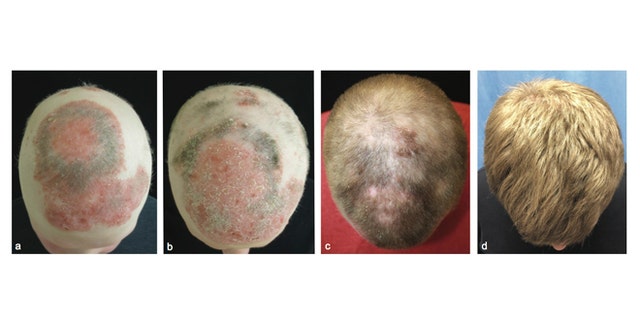 Images showing the alopecia patient during treatment with tofacitinib to regrow his hair. 1st panel- before treatment. 2nd panel- 2 months into treatment. 3rd panel- 5 months into treatment. 4th panel- 8 months into treatment.