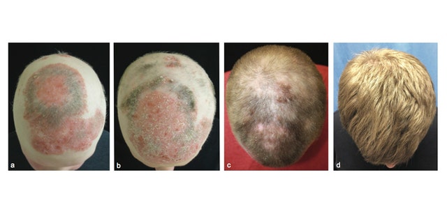 Images showing the alopecia patient during treatment with tofacitinib to regrow his hair. 1st panel- before treatment. 2nd panel- 2 months into treatment. 3rd panel- 5 months into treatment. 4th panel- 8 months into treatment.