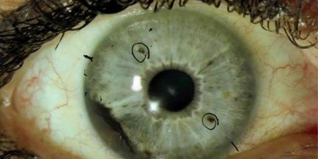 Ocular melanoma can be detected by people who have spots in their iris.