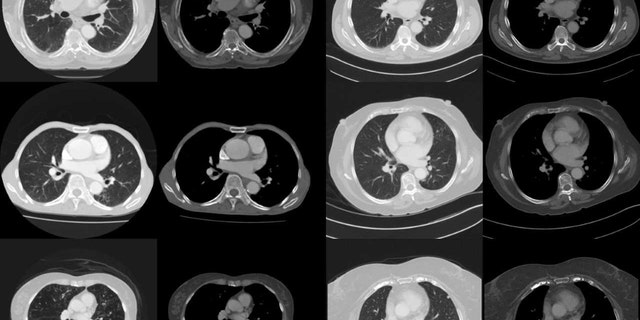 Two of the images of the proximal left anterior descending coronary artery used in the study. The mortality cases (left side) display prominent visual changes of emphysema, cardiomegaly, vascular disease and osteopaenia, while the survival cases on the right appear visually less diseased and frail. (Credit: University of Adelaide)