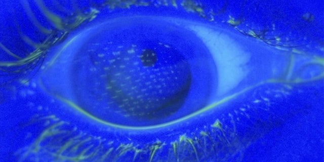 Under a blue light, fluorescein staining of the eye reveals an imprint of the nylon mesh pattern of the airbag cover on the corneal surface of the right eye.