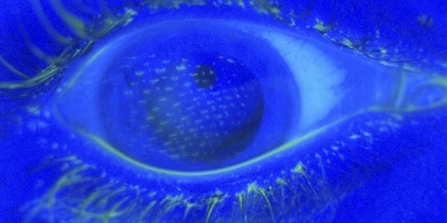 Under a blue light, fluorescein staining of the eye reveals an imprint of the nylon mesh pattern of the airbag cover on the corneal surface of the right eye.