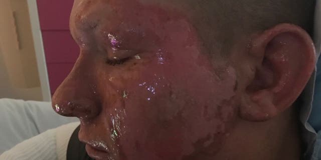 A Virginia teen is recuperating after he was burned by hogweed.