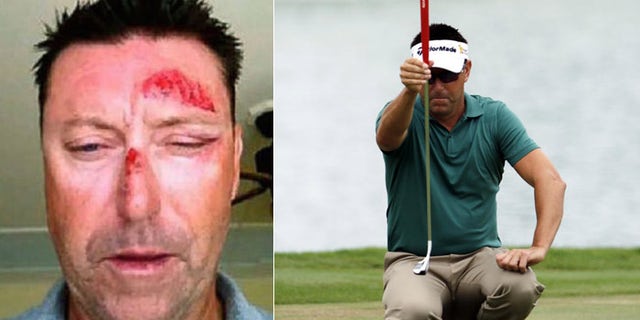 A photo Allenby tweeted following the incident shows facial injuries. He has pulled out of his next tournament. (Twitter, AP)