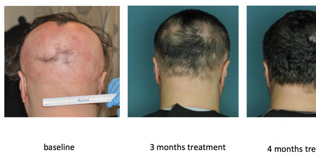 alopecia treatment columbia u