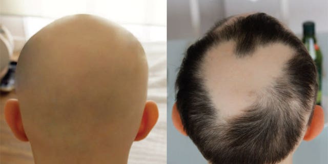 An image of a patient with alopecia universalis, a condition that results in hair loss. On the left, the patient's head before treatment with the drug tofacitinib. On the right, the head after treatment.