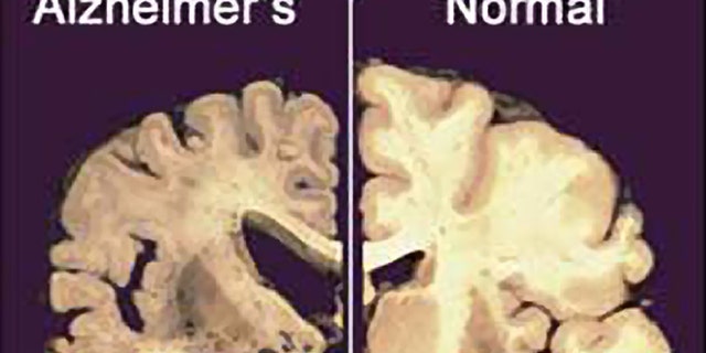 This undated file image provided by Merck & Co., shows a cross section of a normal brain, right, and one of a brain damaged by advanced Alzheimer's disease. A dramatic shift is beginning in the disappointing struggle to find something to slow the damage of Alzheimer's disease: The first U.S. experiments with "brain pacemakers" for Alzheimer's are getting under way. Scientists are looking beyond drugs to implants in the hunt for much-needed new treatments.