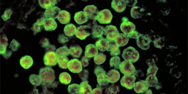 Amebic meningoencephalitis due to Naegleria fowleri.