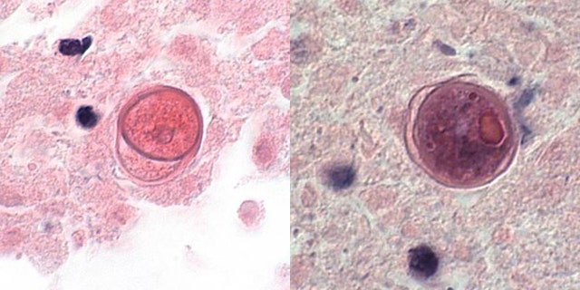 Balamuthia mandrillaris