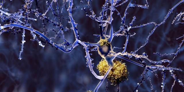 An image of amyloid plaques.