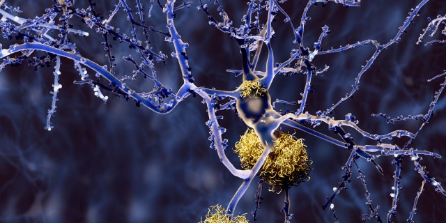 An image of amyloid plaques.